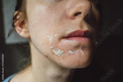 Woman's face after chemical peeling. Peeling skin on the face. Exfoliation of old skin problems, acne, blackheads. photo