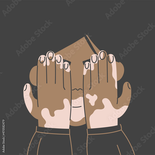 A girl with vitiligo hides behind her hands with a smile