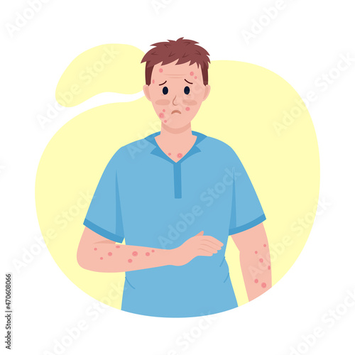 Man with skin rash semi flat color vector character. Posing figure. Full body person on white. Post covid syndrome isolated modern cartoon style illustration for graphic design and animation