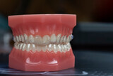invisible braces orthodontic removable aligners for teeth treatment