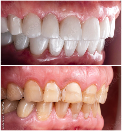 teeth indirect restoration and making new smile by ceramic veneers b1 color