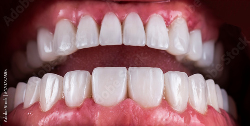 teeth indirect restoration by ceramic crowns and veneers