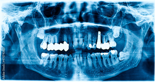 Panoramic radiograph dental X-Ray of a Caucasian male. Panoramic X-Ray of a mouth with dental implant, wisdom teeth and dental fillings. Concept of dental treatment and prevention.