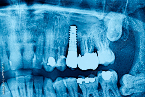 Radiograph dental X-Ray of a Caucasian male with dental implant. Concept of dental implantology