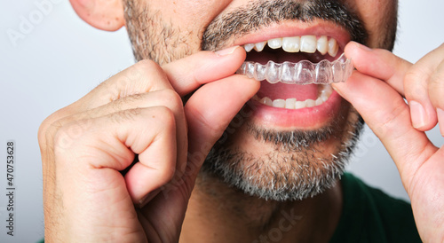 man with transparent dental retainer photo
