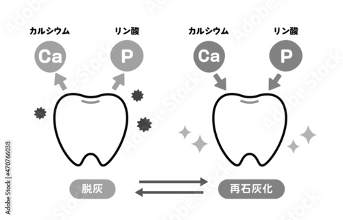 脱灰と再石灰化に関する歯のイラスト