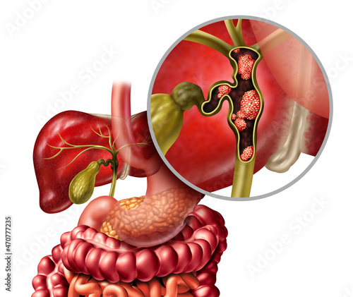 Foto Bile Duct Cancer
