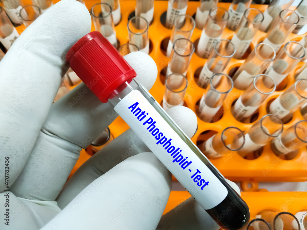 Blood Sample tube for Anti phospholipid Test. To diagnosis abnormal