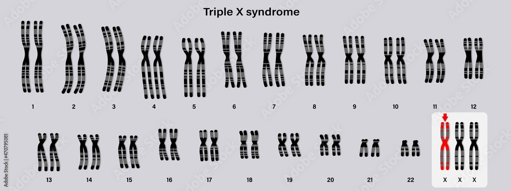 Human Karyotype Of Triple X Syndrome Xxx Female Has An Extra X Chromosome Stock ベクター Adobe 