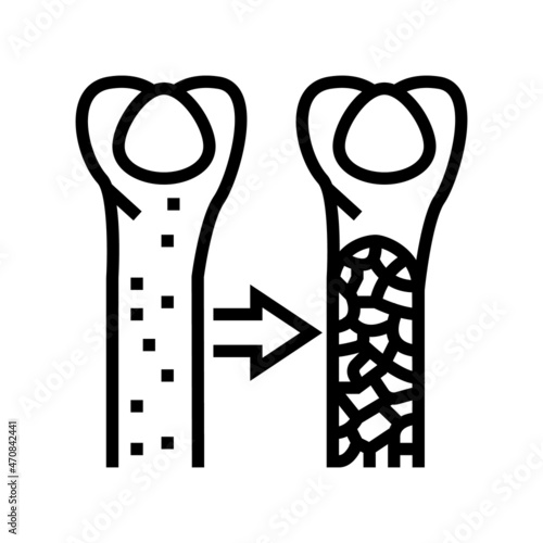 osteoporosis bone disease line icon vector. osteoporosis bone disease sign. isolated contour symbol black illustration