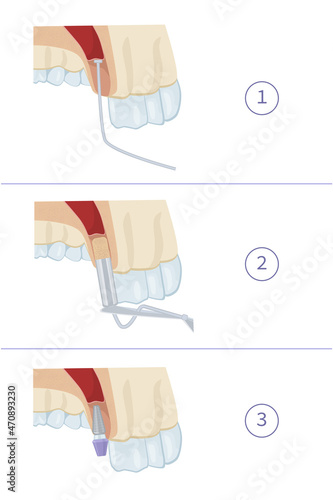 Dental treatment. Closed sinus lift. Dental services. Vector illustration for dental textbooks
