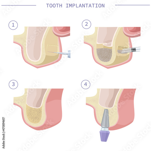 Dental treatment. Open sinus lift. Dental services. Vector illustration for dental textbooks. Step-by-step instruction