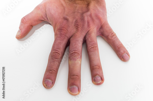 Hand with Psoriatic onychodystrophy or psoriatic nails. psoriasis unguium photo