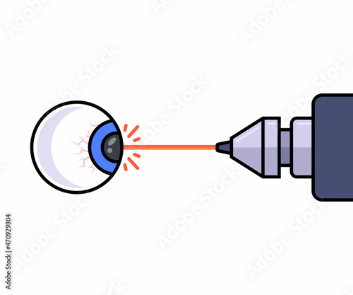 laser vision correction using a laser. flat vector illustration.