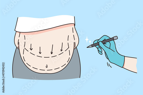 Body care and liposuction concept. Belly of female with overweight and hand of doctor making notes of surgery operation vector illustration 