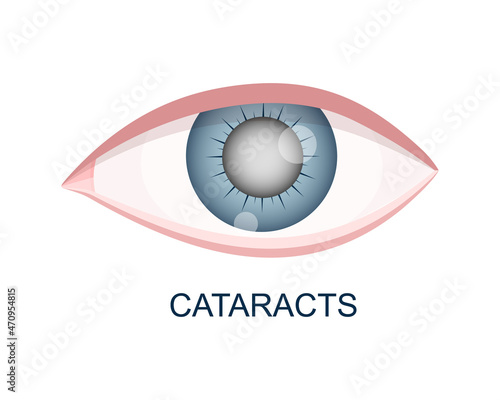 Cataract eye close up view. Eyeball with cloudy lens. Anatomically accurate human organ of vision with aging problems isolated on white background. Vector realistic illustration.
