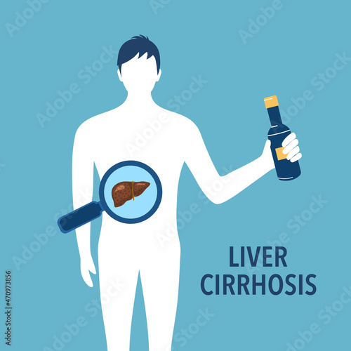 Drinking beer or alcohol beverage can damage liver. Liver cirrhosis disease vector illustration. Healthcare concept.