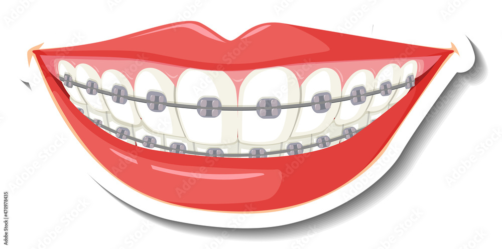 Teeth with braces on white background Teeth with braces on white background