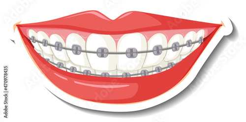 Teeth with braces on white background
