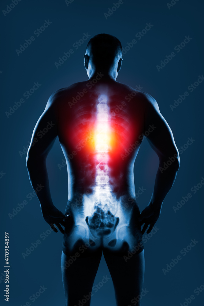 Fototapeta premium Human spine in x-ray on blue background. The thoracic spine is highlighted by yellow red colour.
