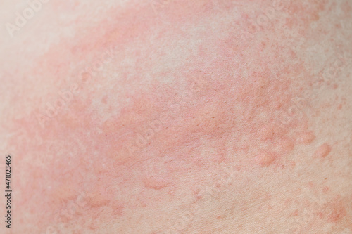 Allergic skin rash prickly heat skin red dot closeup skin problem itching