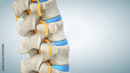 3D animation of a human lumbar spine demonstrating herniated disc, pressure nerve root causing back pain