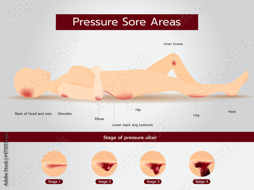 Pressure Sore Areas and Stages of Pressure Sores