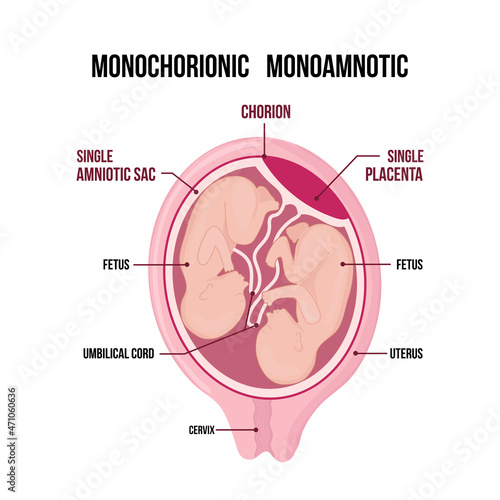 Monochorionic monoamniotic twins medical diagram isolated on white background.