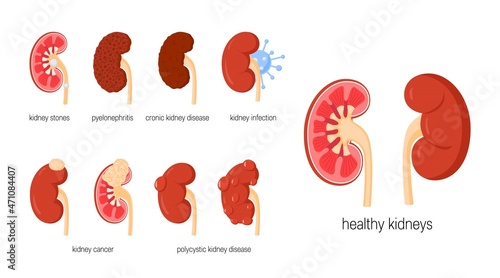 Kidney diseases concept in flat style, vector