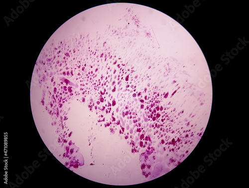 Gram staining, also known as Gram's method, is a method of differentiating bacterial species into two large groups (Gram-positive and Gram-negative). Here, Occasinal gram positive cocci are seen. 4X photo