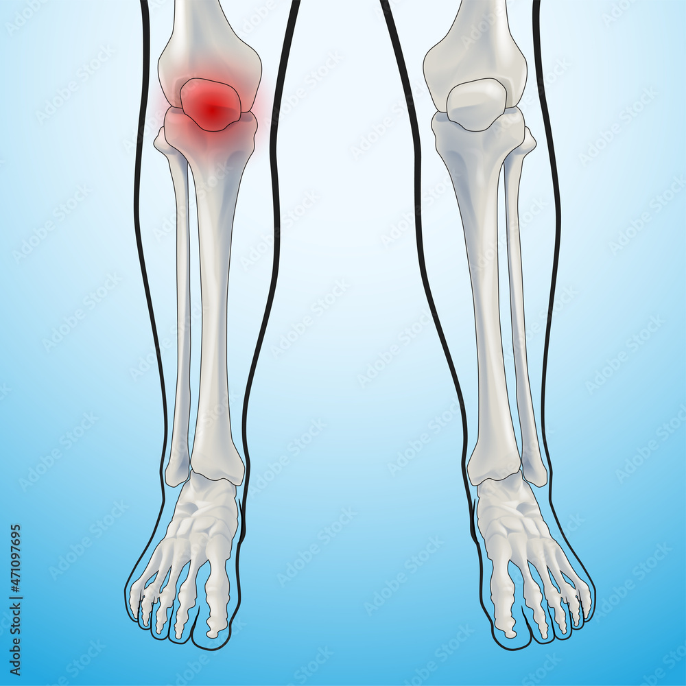 Educational medical illustration of leg bones and horns showing pain. Educational medical illustration of leg bones and horns showing pain.