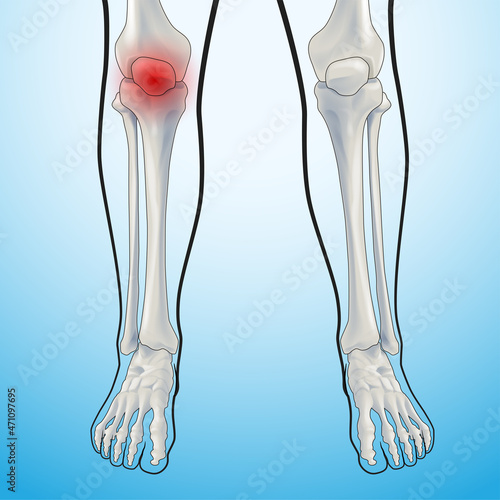 Educational medical illustration of leg bones and horns showing pain.