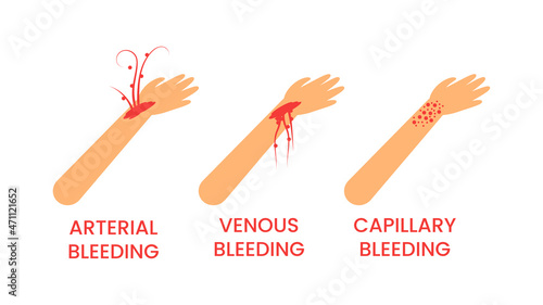 Abstract Flat Doctor Help Types Of Bleeding Venous, Arterial, Capillary First Aid Cartoon People Character Concept Illustration Vector Design Style