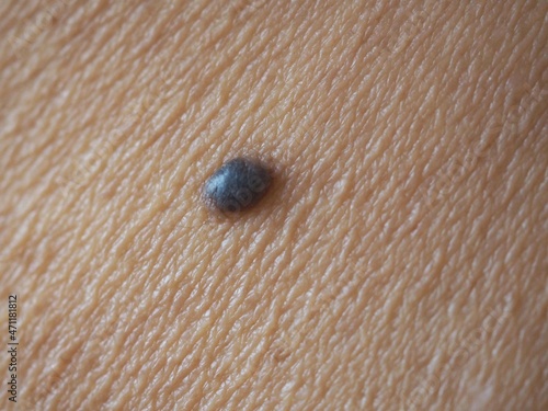 Mole or melanoma black color on abdomen woman of skin lesion case of proliferation of pigment derma cells and melanocytic pigmented naevus, closeup photo, blurred.