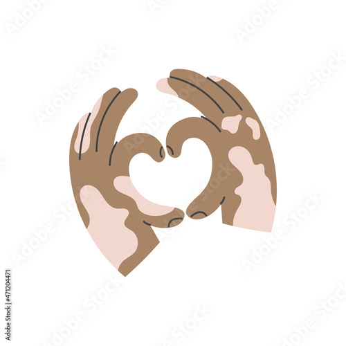 Swarthy hands with vitiligo make a heart shape gesture