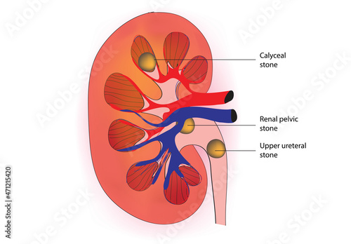 Labeled diagram of kidney stone in the kidney photo