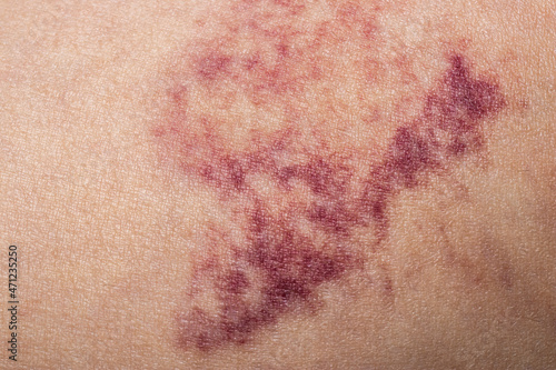Hematoma wound on human skin