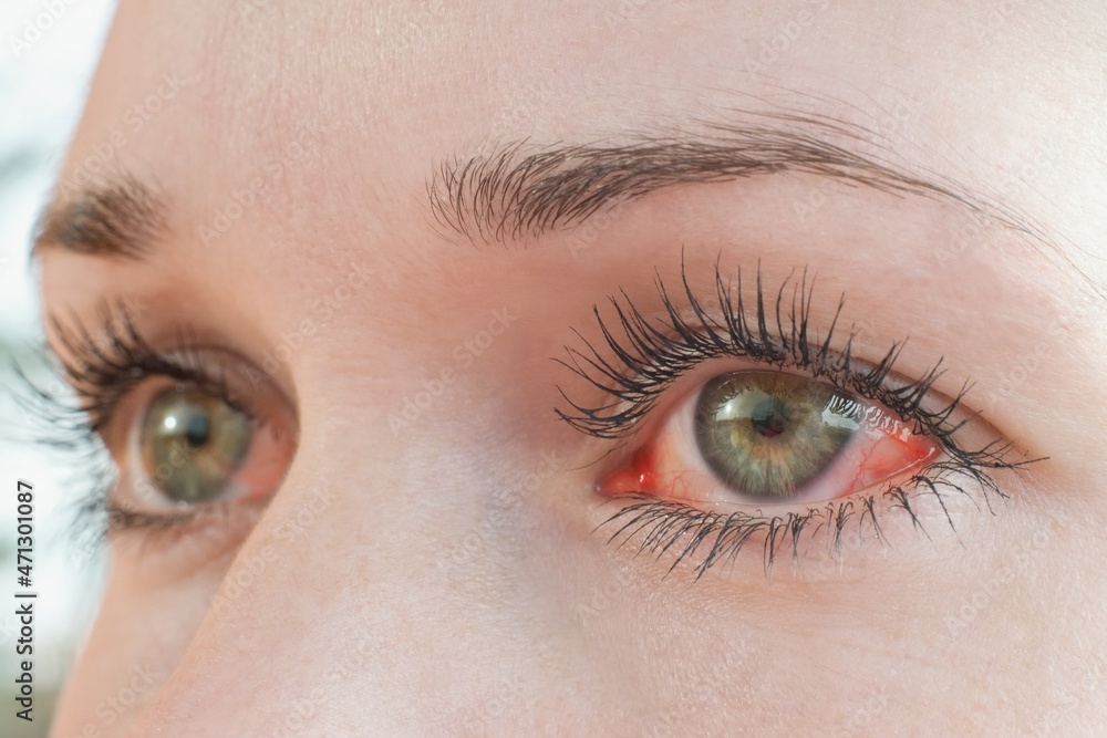Red irritated human eye close up, allergy symptom Red irritated human eye close up, allergy symptom