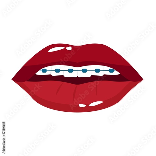 Vector illustration of lips and teeth with braces. Dentistry illustration.