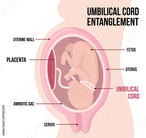 Umbilical cord entanglement around the fetus. Dangerous complication of pregnancy, threat of miscarriage.