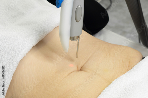 close-up Doctor cosmetologist doing the procedure of laser dermal rejuvenation resurfacing stretch marks of the abdominal skin to the patient. Against the background of a medical office 