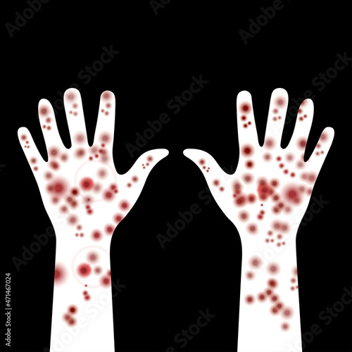 Painful rash on hands. Spots on hands with white skin tone. Symptoms of patient with meningitis. Disease manifestation signs. Rash, dermatitis, allergies or pimples on hands. Medicine or dermatology.