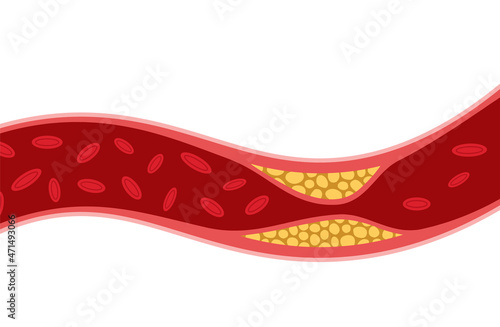 Cholesterol artery thrombosis micro vascular desease. Arteriosclerosis blood vector atherosclerosis risk