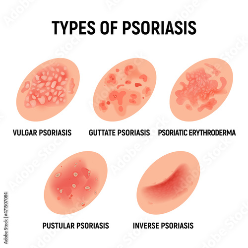 Psoriasis rash vector skin hand infection background. Psoriasis dermatitis eczema cartoon illustration