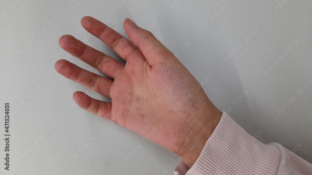 Obraz premium The problem of rashes on the skin of the hands. Red rash on a child's hand.