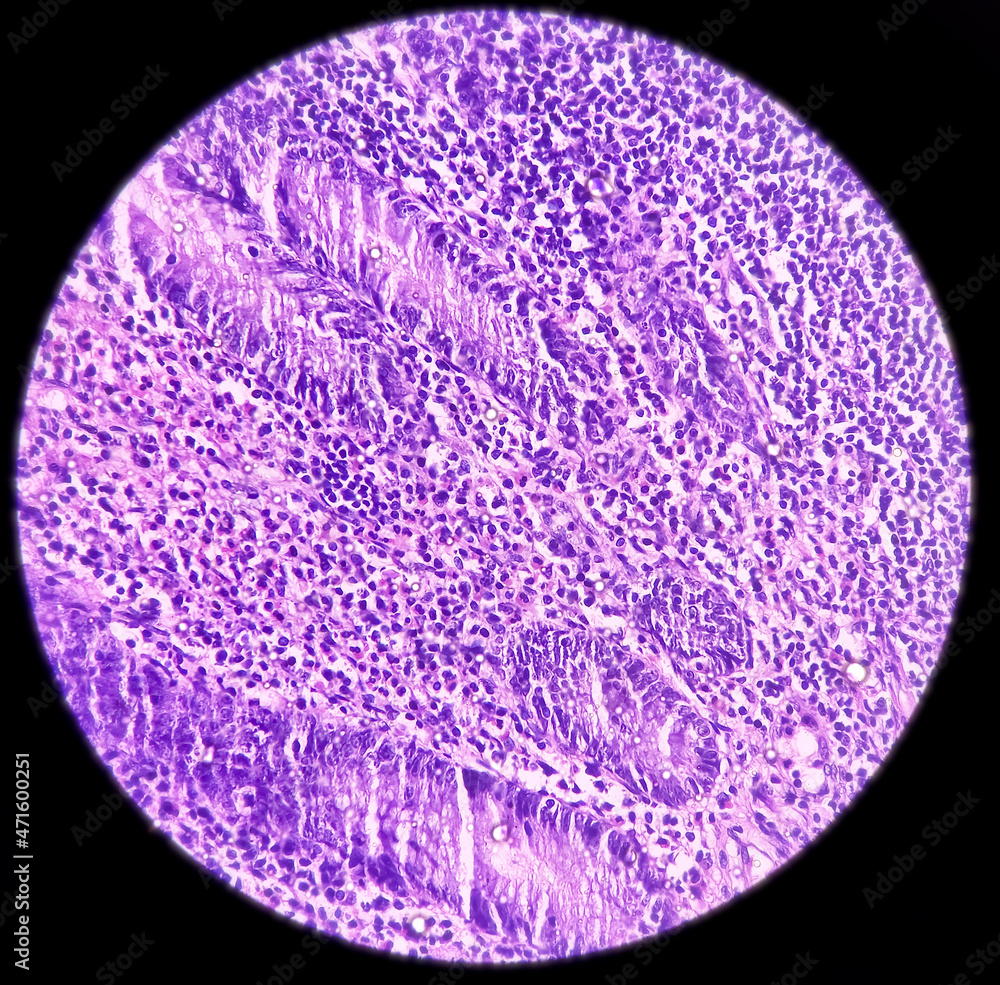 Appendix, Acute appendicitis, show vermiform appendix wall, infiltration of neutrophils in all the layers including muscle layers, 40x microscopic image. Appendix, Acute appendicitis, show vermiform appendix wall, infiltration of neutrophils in all the layers including muscle layers, 40x microscopic image.