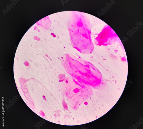 Prostatic smear for Gram Staining microscopic 100x show Neisseria gonorrhoeae bacteria. Gonorrhea is a sexually transmitted disease caused by Neisseria gonorrhoeae bacteria, STD prevention, treatment photo