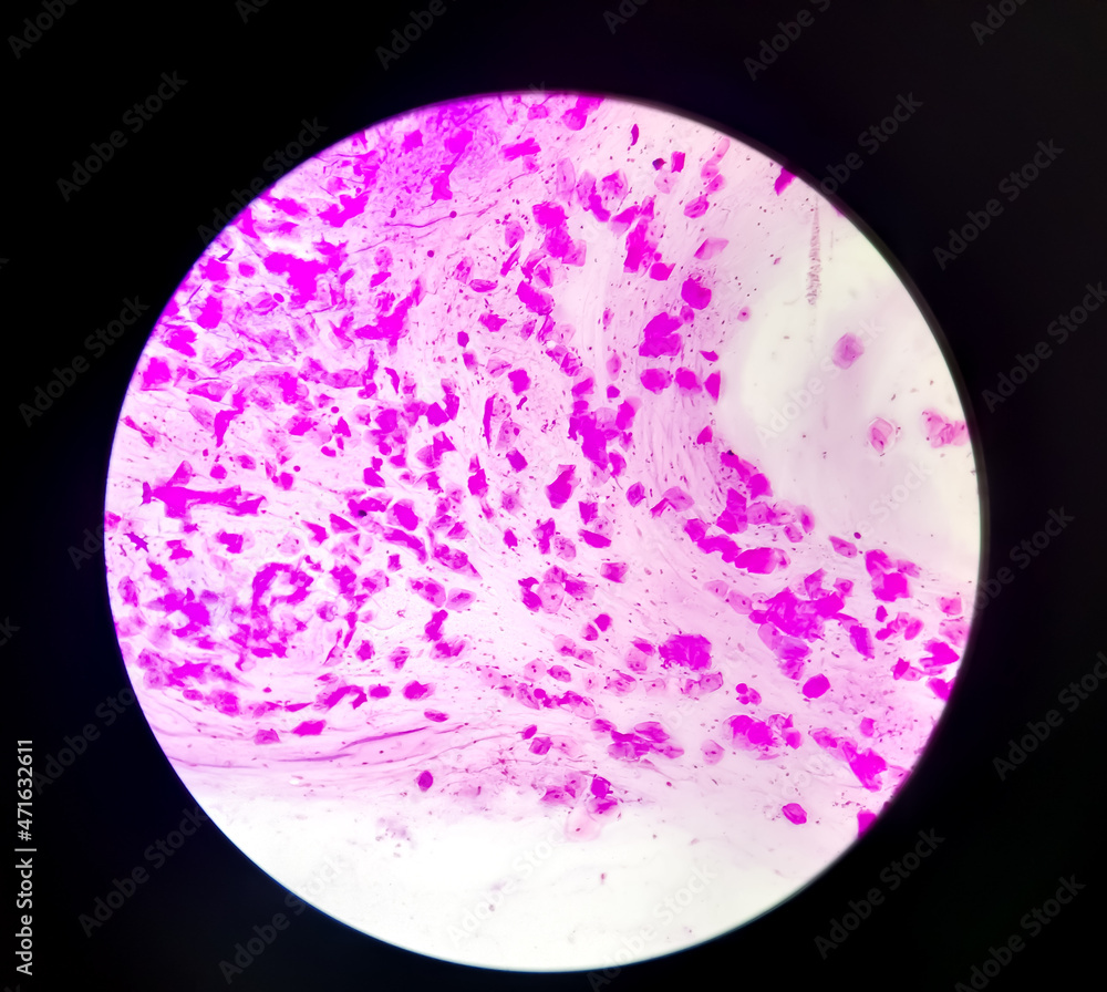 Gram stain Gram positive cocci, Gram positive diplococci bacteria