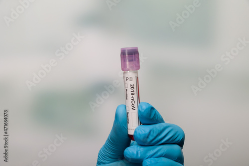 Close up of hands in medical gloves holding a test tube after virus analysis with (antibody) result markers 