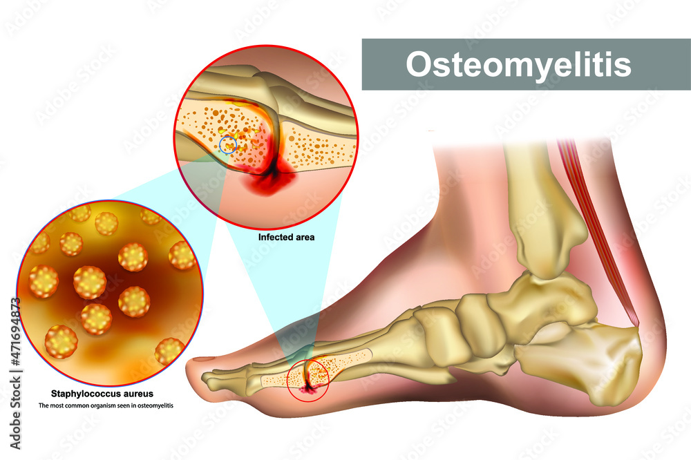 Osteomyelitis is an infection of bone. Staphylococcus aureus most common organism seen in